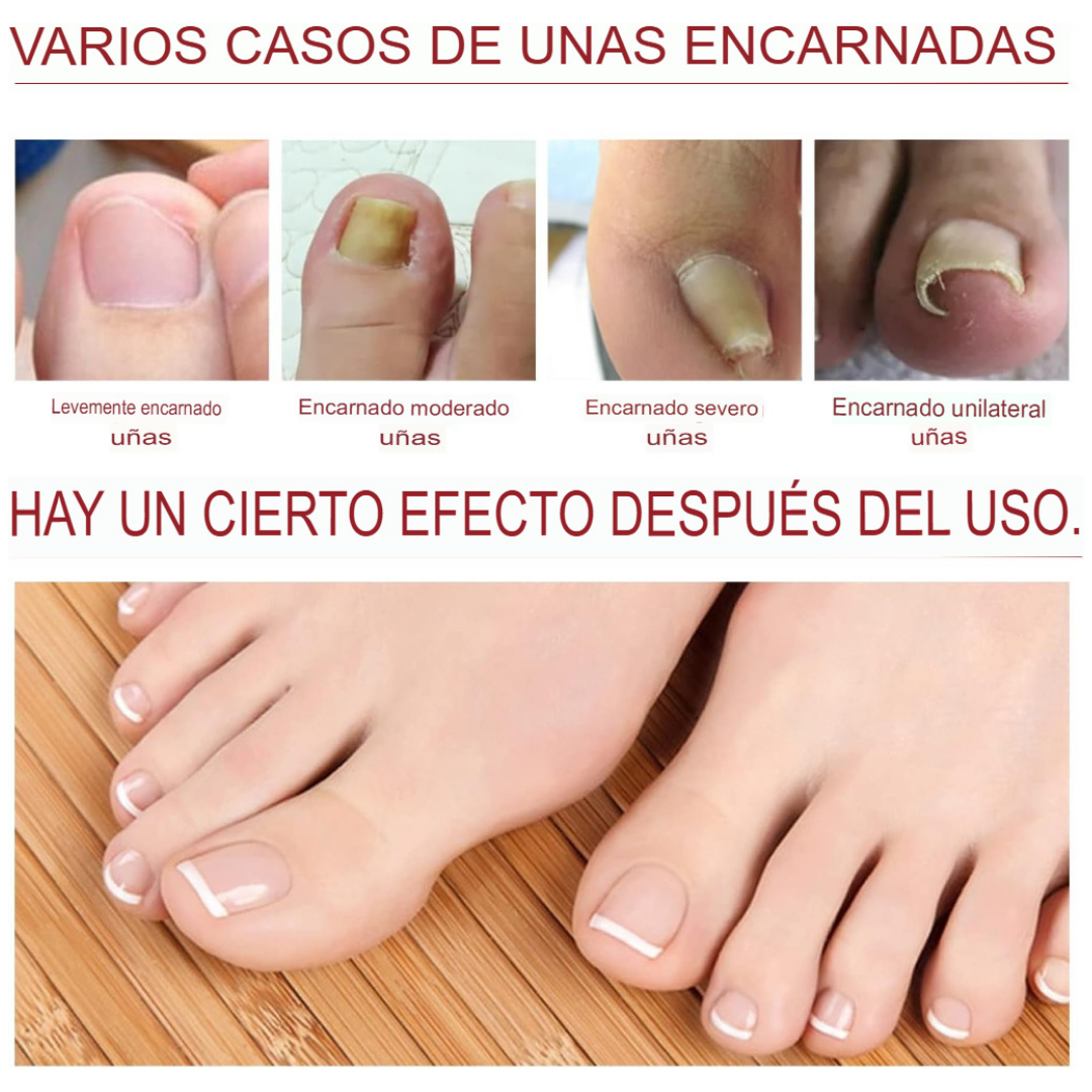 Anti Hongo Toenailplus Elimina Hongos
